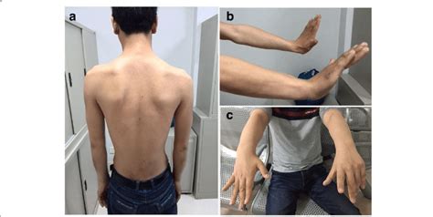 posterior scapular winging test